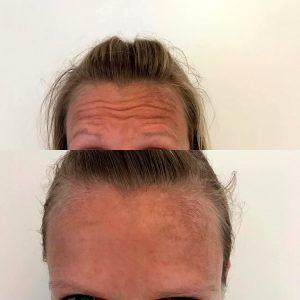 Botox Results Forehead Lines (4)