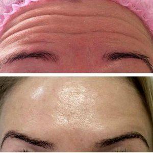Botox Results Forehead Lines (5)