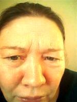botox between eyebrows shots injections facial frown lines prices info