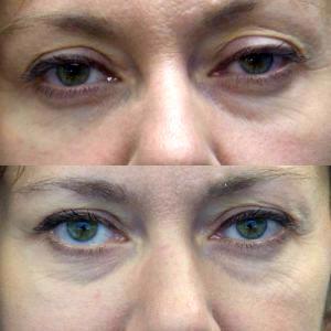 Botox To Correct Eyelid Ptosis By Dr. Christine Hamori, Plastic Surgeon In Duxbury, MA
