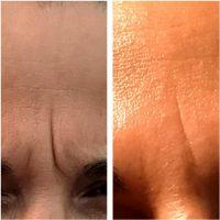 Botox To Correct The Brow Furrow Before And After