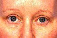 Botox To Crows Feet And Between Eyes (Glabella) Before And After By Doctor Grant Stevens, MD, Los Angeles Plastic Surgeon 78