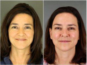 Botox To Forehead And Between Eyebrows By Patti Flint MD PC, MD, Scottsdale AZ Plastic Surgeon (1)