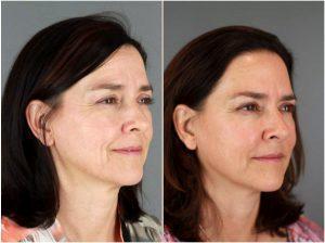 Botox To Forehead And Between Eyebrows By Patti Flint MD PC, MD, Scottsdale AZ Plastic Surgeon (3)