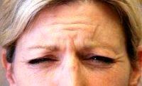 Botox To Forehead And Frown Wrinkles By Dr Craig N. Creasman, MD, San Jose Plastic Surgeon