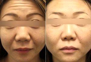 Botox To Forehead And Glabella Before And After By Doctor Jessica J. Krant, MD, MPH, New York Dermatologic Surgeon