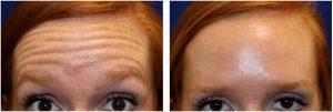 Botox To Forehead And Glabella By Dr. Matthew Richardson, MD, Frisco TX Facial Plastic Surgeon (1)