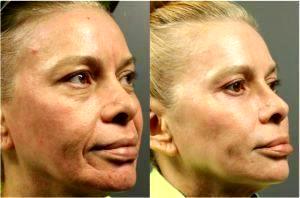 Botox To Forehead And Glabella; Filler To Temples, Midface, Nasolabial Folds And Chin By Ashley Gordon, MD, FACS, Austin Female Plastic Surgeon