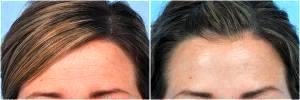 Botox To Forehead, Around Eyes And Glabellar Region By Dr. Steven H. Dayan, MD, Doctor In Chicago, Illinois