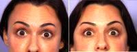 Botox To Forehead By Dr Grant Stevens, MD, Los Angeles Plastic Surgeon