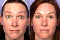 Botox To Forehead With Dr Grant Stevens, MD, Los Angeles Plastic Surgeon