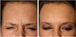 Botox To Frown Lines By Dr. David Verebelyi, MD, Englewood, CO Plastic Surgeon (1)