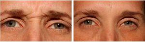 Botox To Frown Lines By Dr. David Verebelyi, MD, Englewood, CO Plastic Surgeon (2)