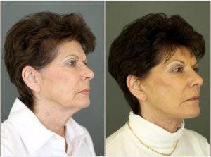 Botox To Glabella By Patti Flint MD PC, MD, Scottsdale AZ Plastic Surgeon (3)