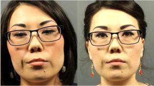 Botox To Masseters By Ashley Gordon, MD, FACS, Austin Female Plastic Surgeon