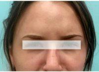 Botox To Smooth Number '11' Forehead Wrinkles On A 26 Year Old Woman With Dr Jia Zheng, MD, Vancouver Physician
