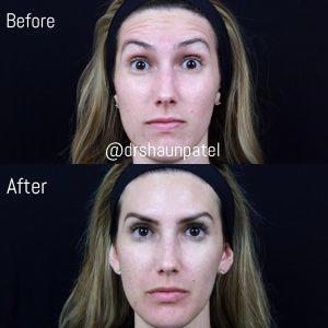 Botox To Soften Her Forehead Lines By Dr. Shaun Patel, MD, Coral Gables FL Physician