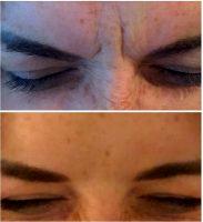 Botox To Treat Frown Lines Photo Before And After