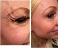 Botox To Treat Lines On The Upper Half Of The Face
