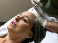 Botox Treatment For Forehead