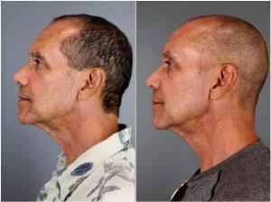 Botox Treatment To His Crow's Feet, Between Eyebrows, And To The Corners Of His Mouth By Patti Flint MD PC, MD, Scottsdale AZ Plastic Surgeon (4)