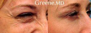 Botox Treatment To Minimize The Appearance Of Crows Feet By Dr. Ryan Greene, MD, PhD, Fort Lauderdale Facial Plastic Surgeon