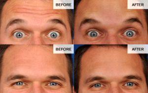 Botox Treatment To The Forehead And Crow's Feet By Dr. David Broadway, Denver Plastic Surgeon