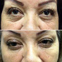 Botox Treatments Can Help Reduce Some Kinds Of Wrinkles