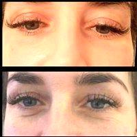 Botox Treatments For Under Eyes Before And After