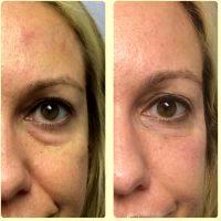 Botox Under Eye Bags Before And After