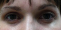 Botox Used To Treat Eye Wrinkles And Change Eye Shape With Dr Jason Emer, MD, Los Angeles Dermatologic Surgeon