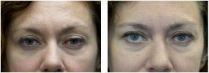 Botox Used To Treat Ptsosis (droopy Eyelid) By Dr. Christine Hamori, Plastic Surgeon In Duxbury, MA