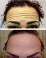 Botox Vs. Dermal Fillers For Forehead Wrinkles