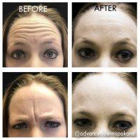 Botox Work On Deep Forehead Wrinkles