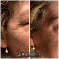 Botox Works To Erase Facial Lines Such As Crows Feet