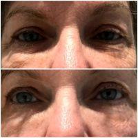 Botox Works Well For Forehead Lines, Crow's Feet, Frown Lines