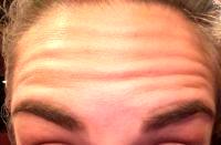 Botox Wrinkles Forehead Lines