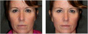 Botox for wrinkles and finelines by Dr. Otto J. Placik, Chicago Plastic Surgeon (1)