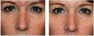 Botox for wrinkles and finelines by Dr. Otto J. Placik, Chicago Plastic Surgeon (2)