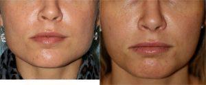 Botox to Masseters by Dr. Otto J. Placik, Chicago Plastic Surgeon