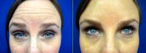 Botulinum Toxin Before & After Right Periocular Area (crow's Feet) By Dr. Martin Kassir, Dallas Plastic Surgeon