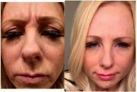 Botulinum Toxin Frown Lines Before And After