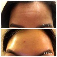 Botulinum Toxin Type A Before And After Forehead