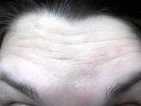 Botulinum Toxin Type A Forehead