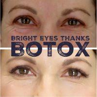 Bright Eyes Thanks To Botox
