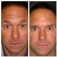 Brotox Botox Overall Result Before And After By Doctor Angela Champion, MD, Newport Beach Plastic Surgeon