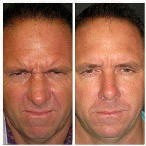 'Brotox' Botox & After Overall Result Before By Doctor Angela Champion, MD, Newport Beach Plastic Surgeon 90275