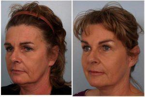 Brow Lift And Botox By Robert Cohen, MD, Plastic Surgeon In Paradise Valley, Arizona