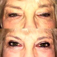 Can Botox Be Used Under The Eyes