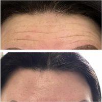 Can Botox Fix Forehead Wrinkles